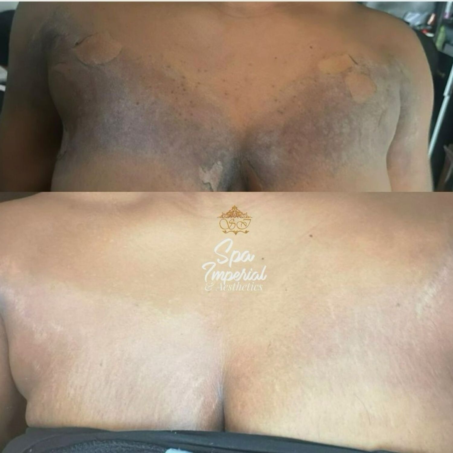 Chemical Peel