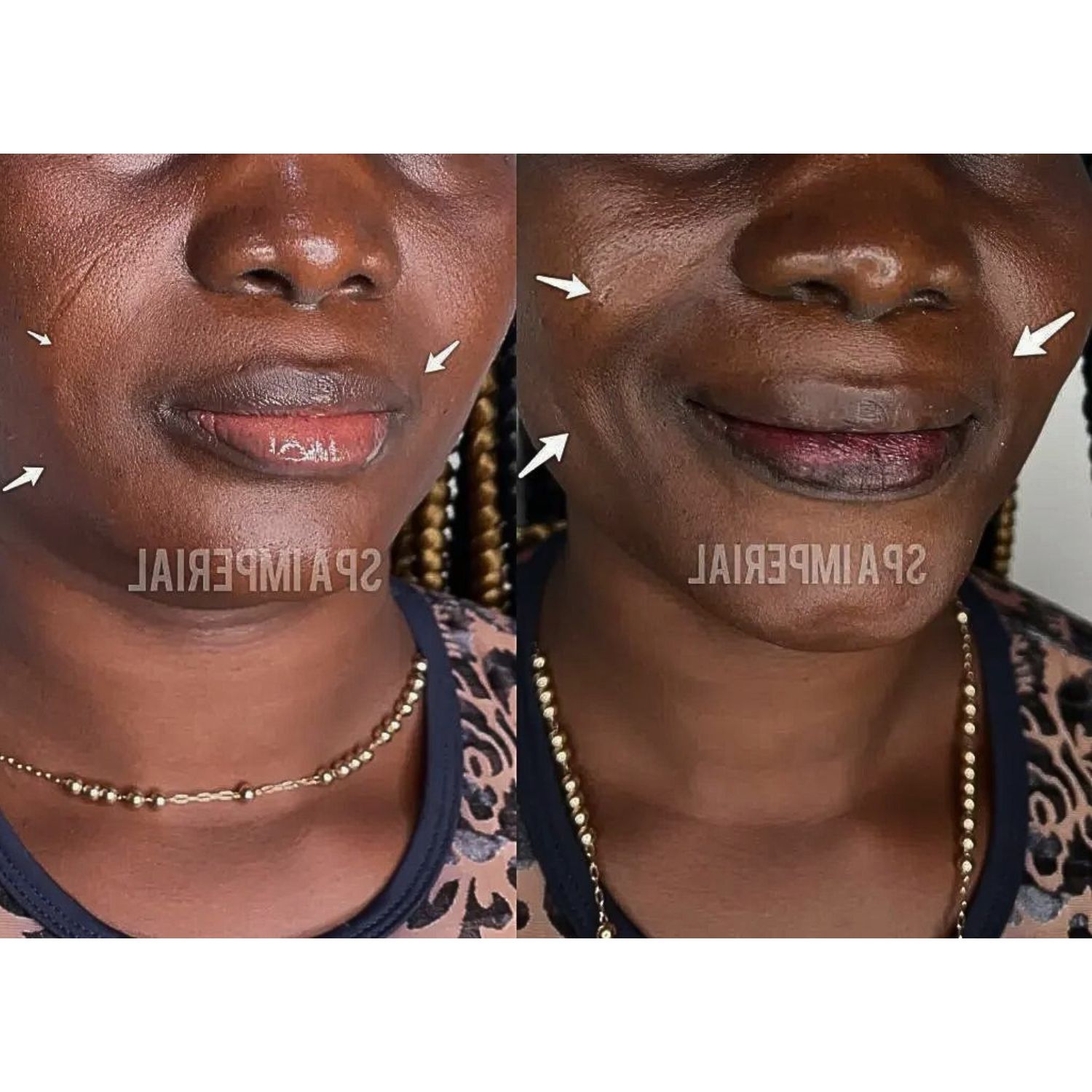 Dermal Fillers