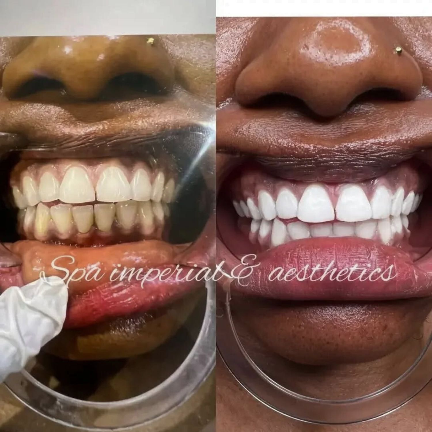 Laser Teeth Whitening