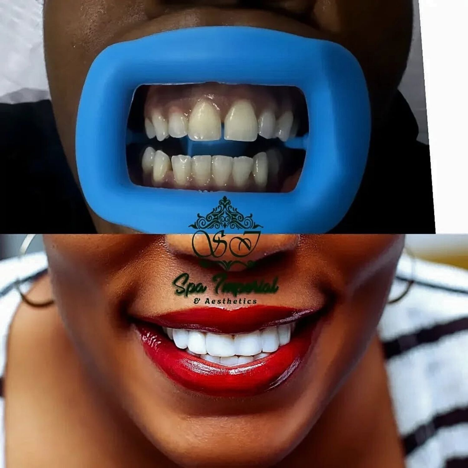 Composite Veneer